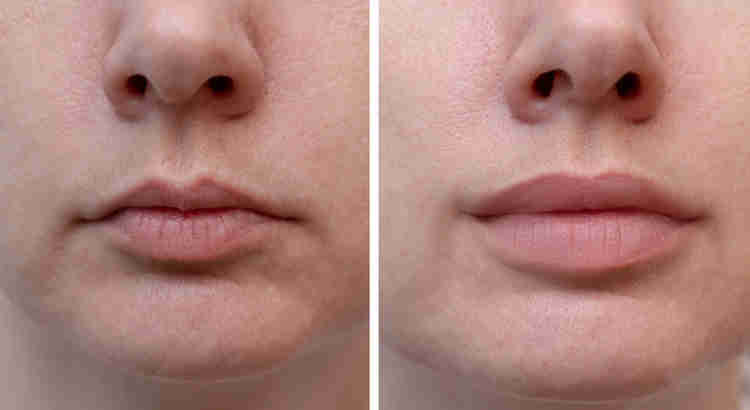 Botox Mallorca Faltenbehandlung Stirn- Zornesfalten Kosten