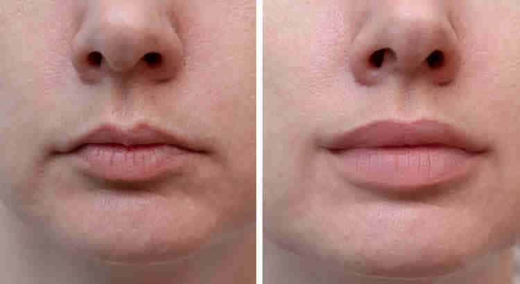Botox Mallorca